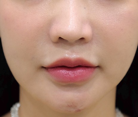 Má lúm đồng tiền