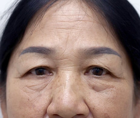 Treo cung mày – Cắt mí dưới