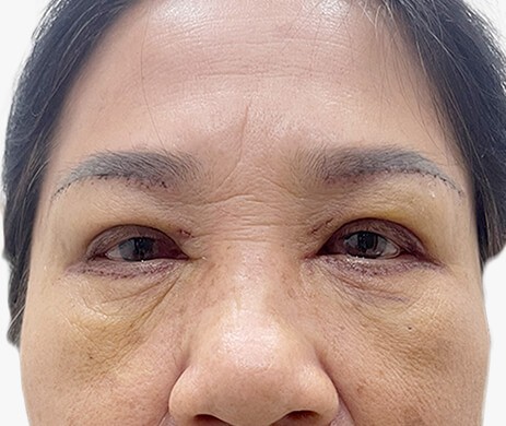 Treo cung mày – Cắt mí dưới