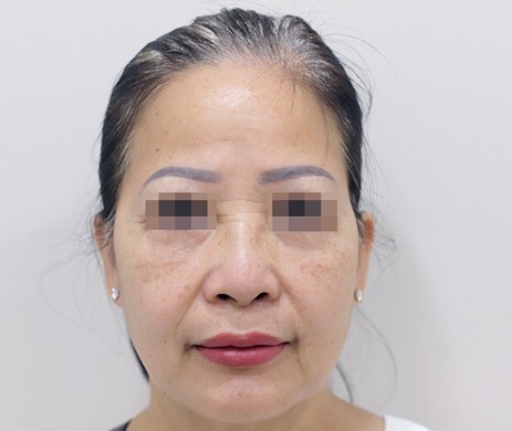 Cấy mỡ trán – thái dương