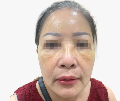 Cấy mỡ trán – thái dương