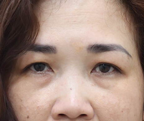 Cắt mí trên – Mí dưới