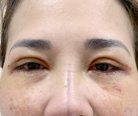 Cắt mí trên – Mí dưới