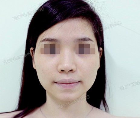 Tiêm Filler Cằm