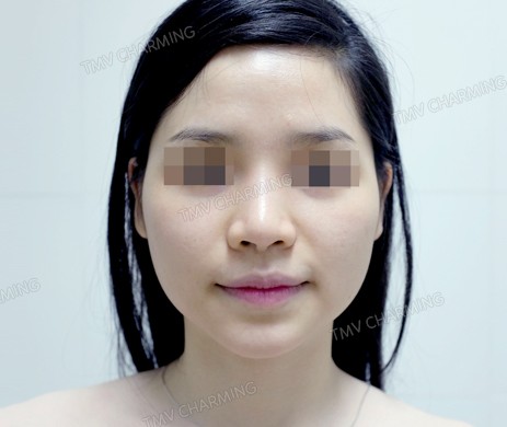 Tiêm Filler Cằm