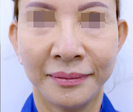 TIÊM FILLER RÃNH MŨI MÁ