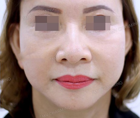 TIÊM FILLER RÃNH MŨI MÁ