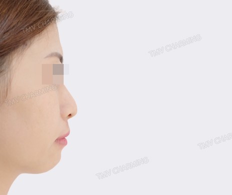 TIÊM FILLER CẰM