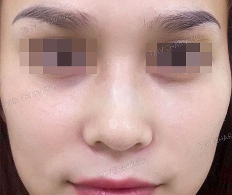 TIÊM FILLER MŨI