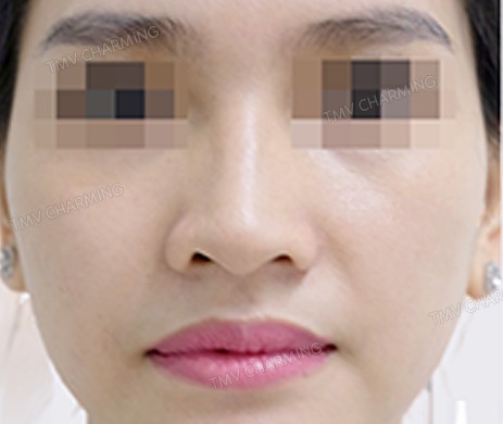 TIÊM FILLER MŨI