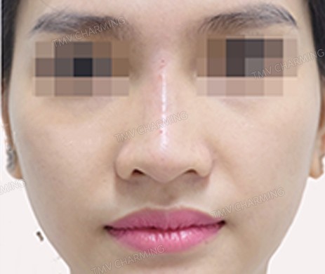 TIÊM FILLER MŨI