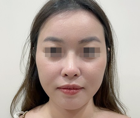 Mũi cấu trúc sụn sườn 1 tháng