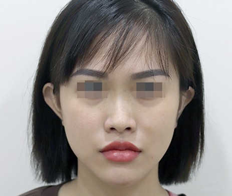 mũi lót sụn – cắt xương