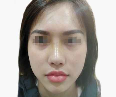 mũi lót sụn – cắt xương