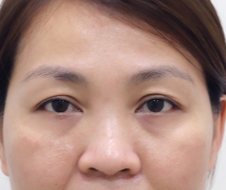 Cắt mí trên + cấy mỡ mí dưới