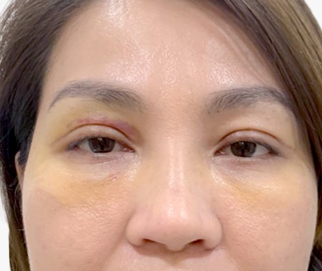 Cắt mí trên + cấy mỡ mí dưới