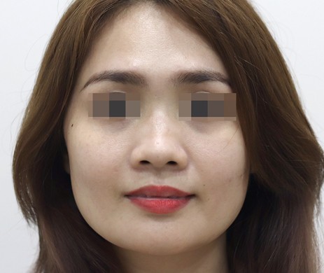 mũi lót sụn – cà gồ