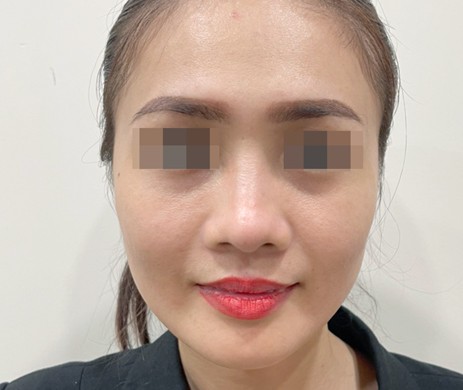 mũi lót sụn – cà gồ