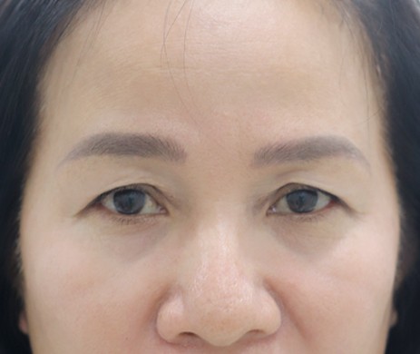 Cắt mí trên + cấy mỡ mí dưới