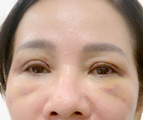 Cắt mí trên + cấy mỡ mí dưới