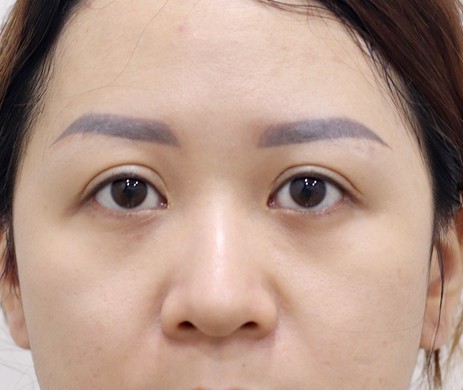 cấy mỡ mí dưới