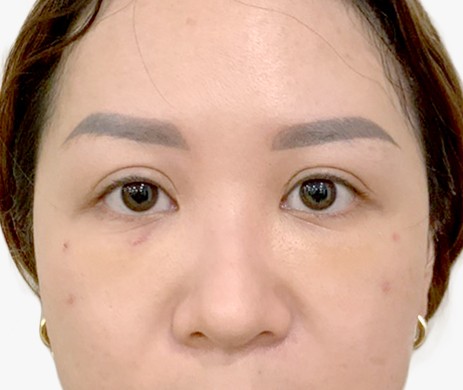 cấy mỡ mí dưới