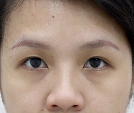 nhấn mí sau 1.5 năm