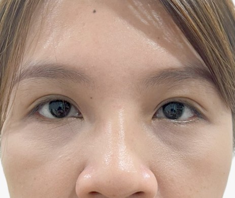 nhấn mí sau 1.5 năm