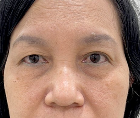 Cắt mí trên – dưới + cấy mỡ mí dưới