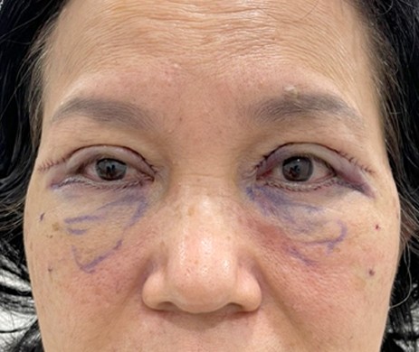 Cắt mí trên – dưới + cấy mỡ mí dưới