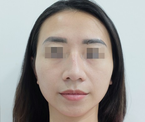 Mũi cấu trúc sụn sườn – cắt xương sau 1 tháng