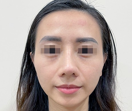 Mũi cấu trúc sụn sườn – cắt xương sau 1 tháng