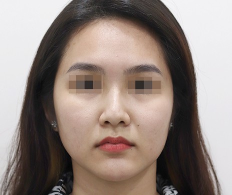 Mũi lót sụn – cắt xương + lấy chỉ mũi