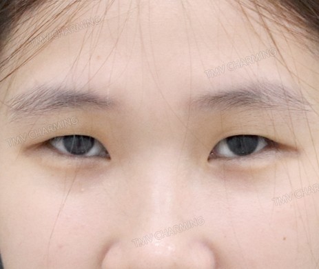 nhấn mí + mở góc mắt trong