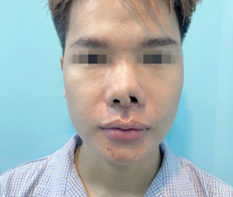 Mũi cấu trúc sụn sườn sửa lại sau 1 tháng