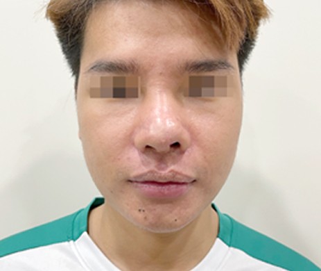 Mũi cấu trúc sụn sườn sửa lại sau 1 tháng