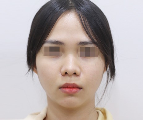 mũi lót sụn + độn cằm