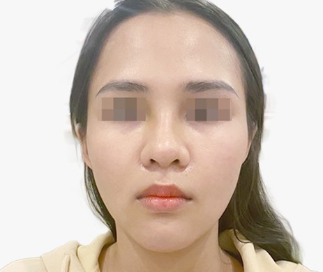 mũi lót sụn + độn cằm