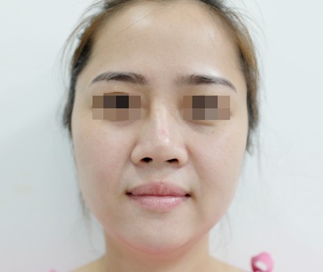 Mũi cấu trúc sụn sườn sửa lại – cắt xương – cắt cánh sau 2.5 tháng