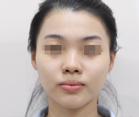 mũi lót sụn – thu chóp