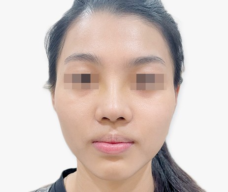 mũi lót sụn – thu chóp