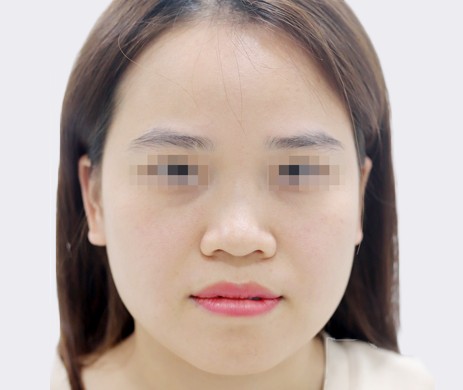 mũi lót sụn – cắt cánh