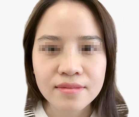 mũi lót sụn – cắt cánh