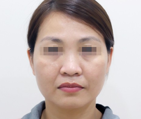 mũi lót sụn – cắt cánh – cắt xương