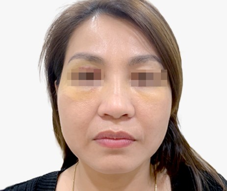 mũi lót sụn – cắt cánh – cắt xương