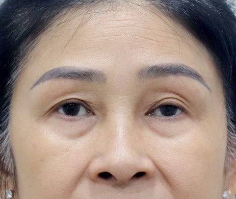 Cắt mí dưới + Cấy mỡ mí trên – dưới