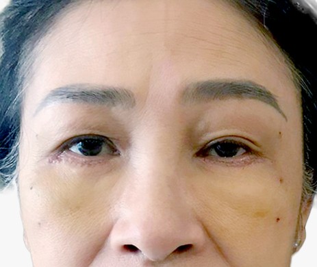 Cắt mí dưới + Cấy mỡ mí trên – dưới