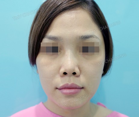 Mũi cấu trúc sụn sườn sửa lại – cắt xương – cắt cánh