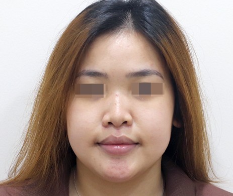 Mũi lót sụn – cắt xương