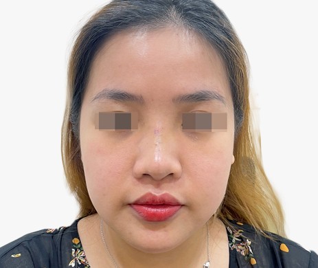 Mũi lót sụn – cắt xương